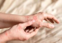 Close-up of a person's hands showing skin irritation and redness