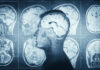 MRI scans of the brain displayed alongside a silhouette of a human head