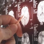 A hand pointing at a brain MRI scan on a screen