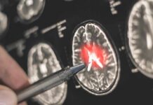 Brain Tumor Crisis: What Scientists Miss A hand pointing at a brain scan with highlighted areas