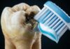 Recurring Cavities and Tooth Decay – Common Causes Why Your Teeth Decay Even If You Brush