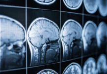 Cognitive Decline Epidemic in Young Adults Close-up of MRI brain scans displayed on a screen