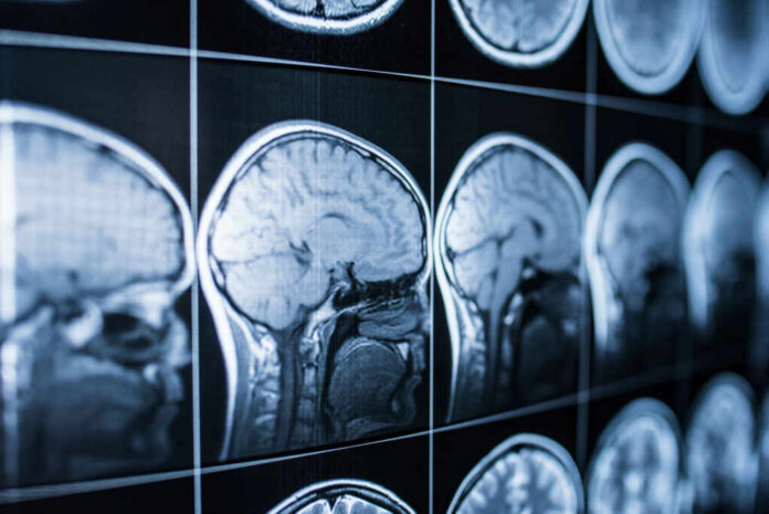 9a3727d6-ff70-4c52-bc15-2dd3fe515569_shutterstock_1113389069 Close-up of MRI brain scans displayed on a screen