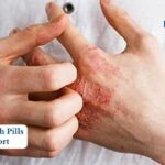 Popular Eczema Remedy May Fall Short