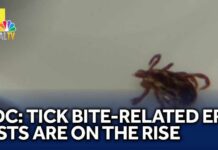 CDC Alarm: ER Tick Bites Surge CDC: Tick bite-related ER visits are on the rise
