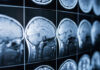 Close-up of MRI brain scans displayed on a screen