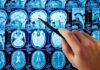 Epigenetics – How Your Mind Can Reprogram Your Genes | Harvard Study Hand pointing at brain MRI scans with a pen