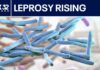 Leprosy cases rising in the US! Leprosy cases increase in the US: Here's what to know