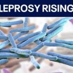 Leprosy cases increase in the US: Here's what to know