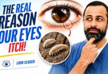 Your Itchy Eyes Might NOT Be Allergies… It Could Be Your Eyelids
