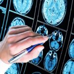 Alzheimer’s Plaque VANISHES After Treatment— Doctors Stunned Hand with pen pointing at brain MRI scans