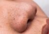 Dermatologists Warn: The Glass Skin Trap close-up of a nose with visible blackheads