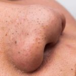Dermatologists Warn: The Glass Skin Trap close-up of a nose with visible blackheads