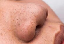 Dermatologists Warn: The Glass Skin Trap close-up of a nose with visible blackheads