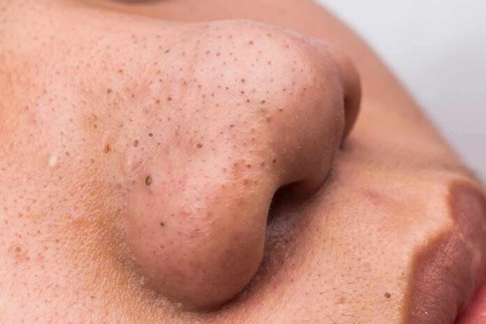 shutterstock_241995088 close-up of a nose with visible blackheads