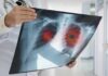 Never-Smokers Stunned By 60X Lung Cancer Risk Doctor holding chest X-ray with highlighted lung areas