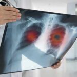 Doctor holding chest X-ray with highlighted lung areas
