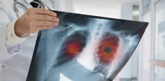 Doctor holding chest X-ray with highlighted lung areas