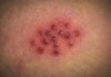 cluster of red pustules on irritated skin