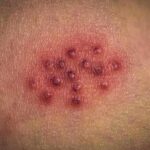 cluster of red pustules on irritated skin