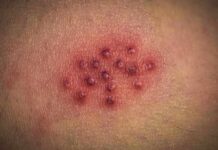 cluster of red pustules on irritated skin
