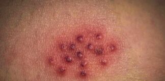 cluster of red pustules on irritated skin
